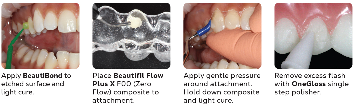 Clear Aligner Procedure Kit